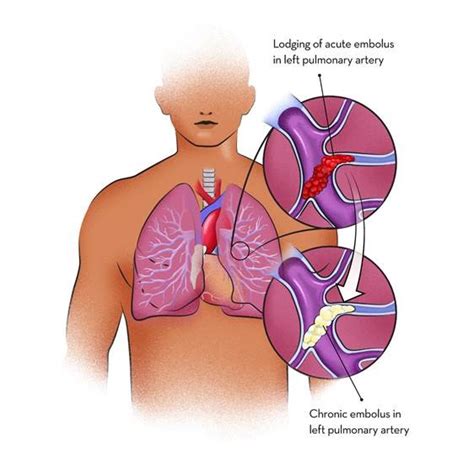 Pulmonary Embolism: Causes, Symptoms, Types, Risk Factors, and Treatment