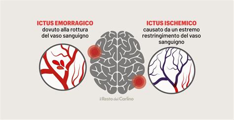 Ictus: riconoscere i sintomi e cosa fare