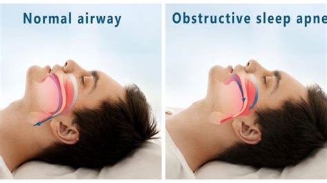 All About Mouth Guards for Sleep Apnea - The Sleep Judge