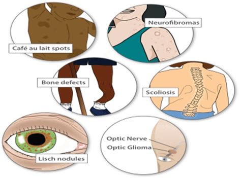 Neurofibromatosis Type-1 (NF1) – Decode Genomics