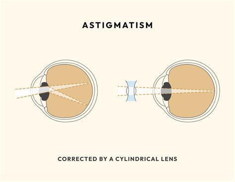 Glasses for Astigmatism Explained | Blog | Eyebuydirect