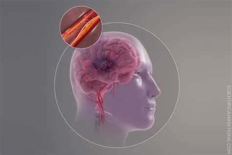 The Term Cerebral Thrombosis Is Defined as - Giovani-has-Townsend