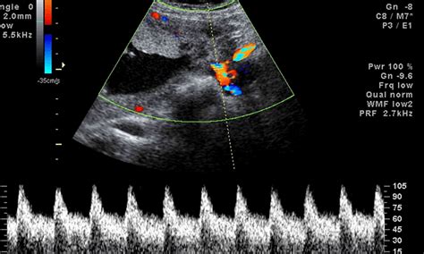 ECOCARDIOGRAFÍA FETAL - Unifetus5D Dra. Nicol Corredor Ginecóloga Obstetra. Perinatólogo