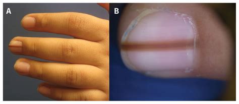 Hutchinson Sign Nail Melanoma - Nail Ftempo