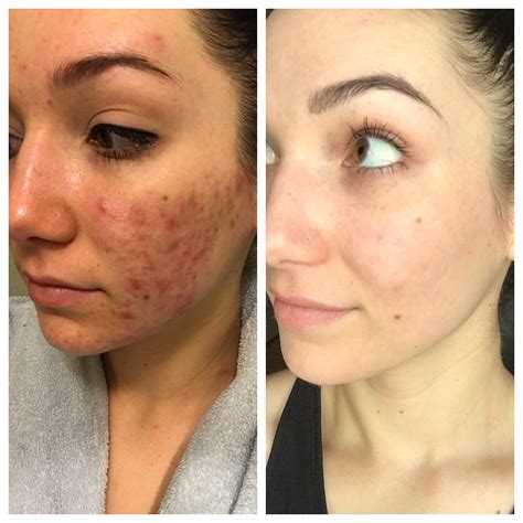 Before and 9 months after PDT and Spironolactone : r/acne