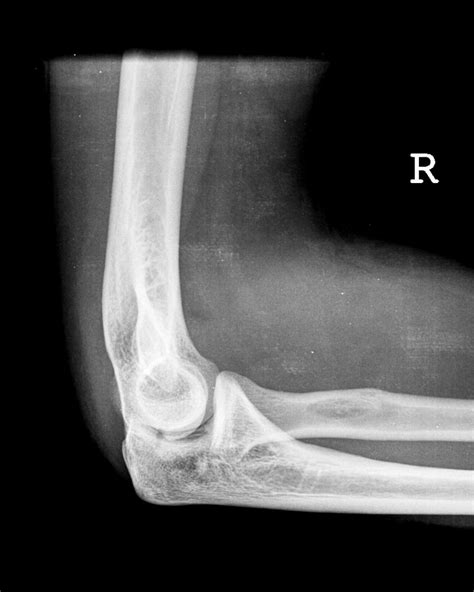 Elbow joint effusion (sail sign) | Image | Radiopaedia.org