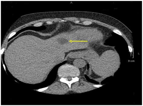 A left liver lobe lobulated hypodense lesion 2.2 × 1.9 cm. | Download ...