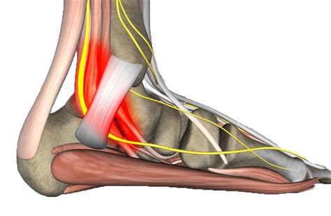 ETF Clinical Case: Tarsal Tunnel Syndrome - O'Brien Medical