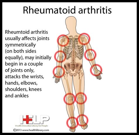 Rheumatoid arthritis symptoms causes and natural support strategies – Artofit