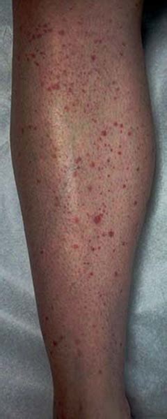 Vasculitis Rash Pictures – the meta pictures