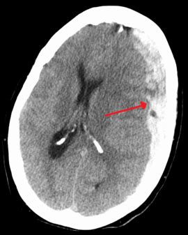 Subdural hematoma - Wikipedia