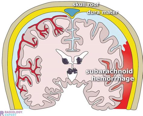 CT brain hemorrhage