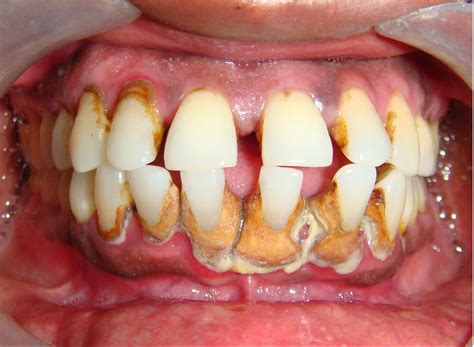 Dental calculus; Tartar