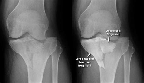 Knee Tibial Plateau Fracture AOA Orthopedic Specialists, 40% OFF