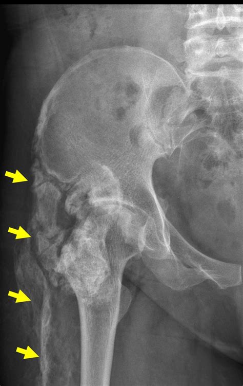 Myositis ossificans – Radiology Cases