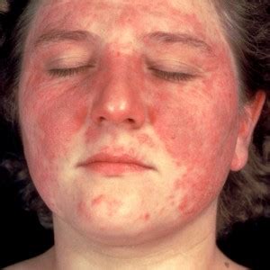 Acne Rosacea Symptoms, Causes, Diagnosis and Treatment - Natural Health ...