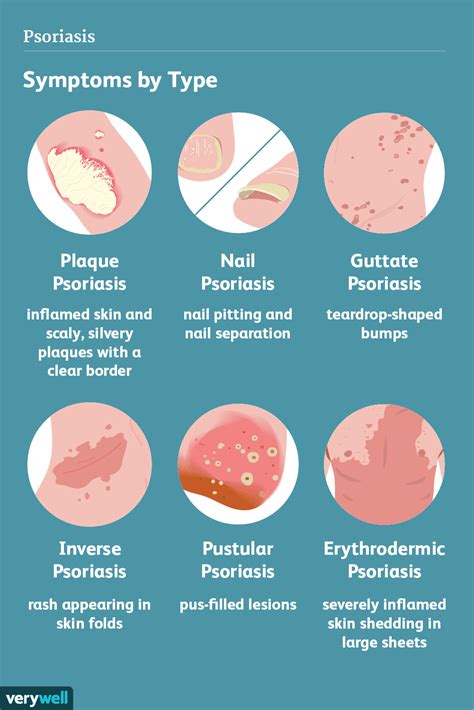 Psoriasis: Symptoms and Complications