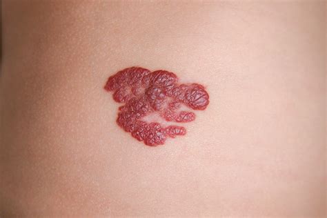 Hemangiomas | Dermatology and Laser Centre of Los Angeles