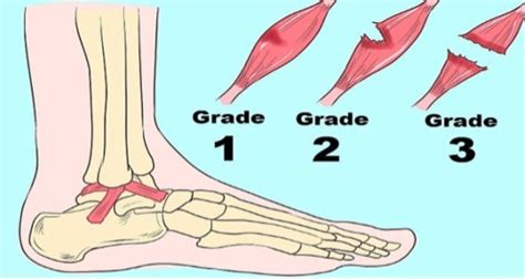 Ankle Sprain Grades