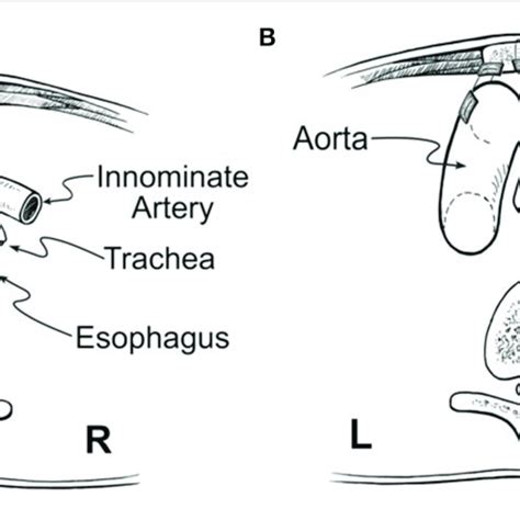 | Posterior and anterior tracheopexy combined with anterior aortopexy.... | Download Scientific ...