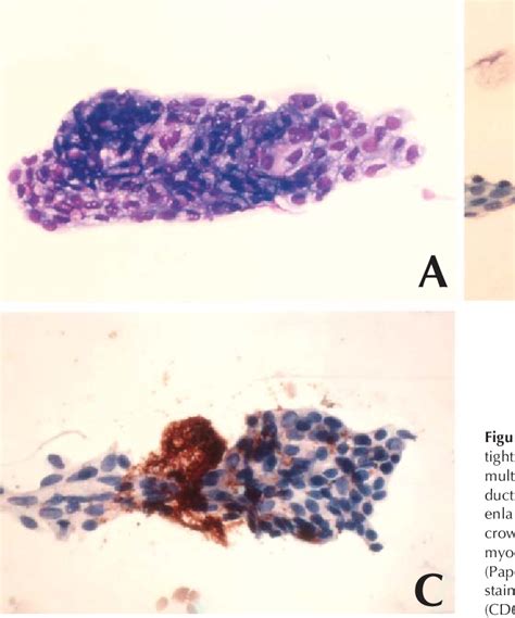 Figure 1 from Fine Needle Aspiration Cytology of Mammary Duct Ectasia ...