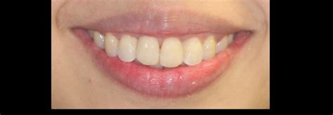 Invisalign NYC| Severe Crowding |Invsalign Brooklyn