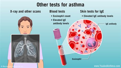 Diagnosing Asthma: Mild, Moderate, and Severe