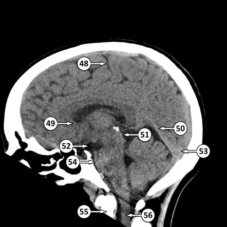 Basal Cisterns Anatomy