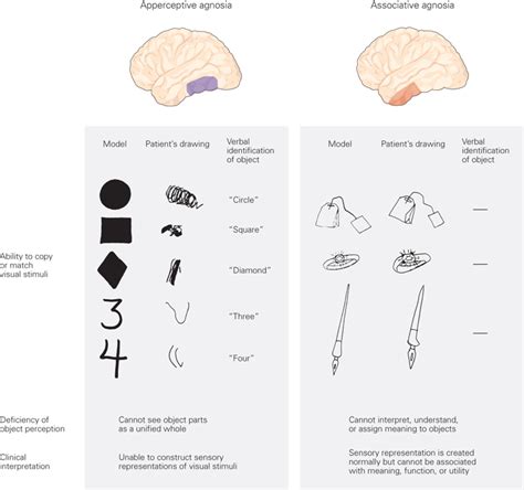 👍 Apperceptive agnosia. Associative Agnosia Video. 2019-02-20