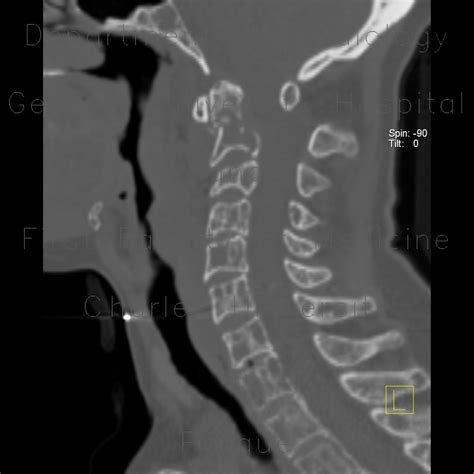 Radiology case: Osteolytic metastasis of cervical spine, fracture of ...