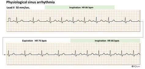 Heart rate