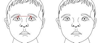 hypertelorism_2 | Noonan Syndrome Awareness Association