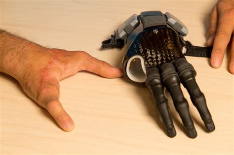 Finger and Partial Hand Prosthetic Options | Arm Dynamics