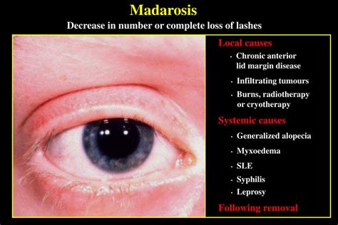 PPT - DISORDERS OF LASHES PowerPoint Presentation, free download - ID:712605