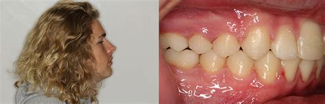 Corrective Jaw Surgery-Orthodontist Charlotte NC|OrthoCare Orthodontics