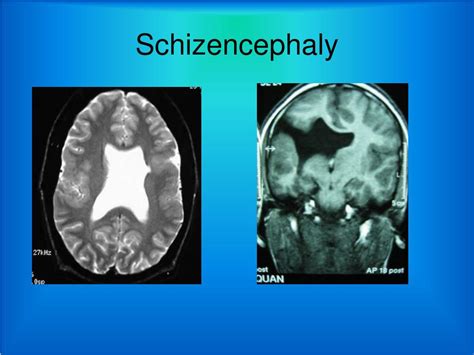 PPT - DEVELOPMENT OF PROSENCEPHALON PowerPoint Presentation, free download - ID:4934794