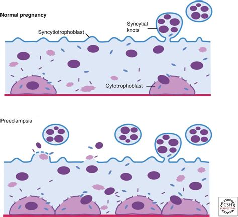 Molecular Mechanisms of Preeclampsia