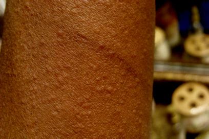 File:Cholinergic urticaria.jpg - Wikipedia