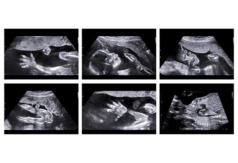 Anomaly Scan during Pregnancy