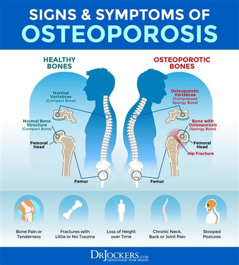 Osteoporosis: Symptoms, Causes and Natural Support Strategies | Osteoporosis, Magnesium ...