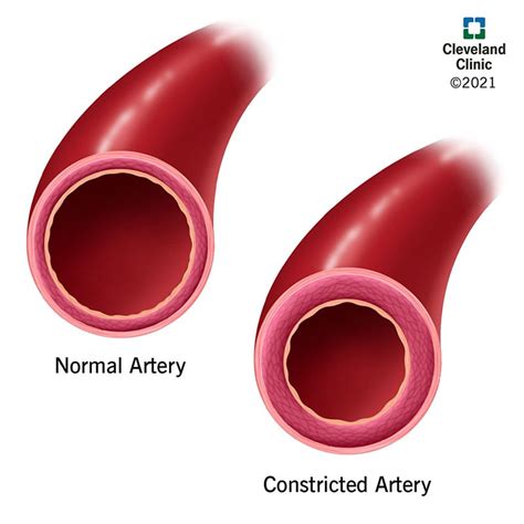 Vasoconstriction: What Is It, Symptoms, Causes & Treatment