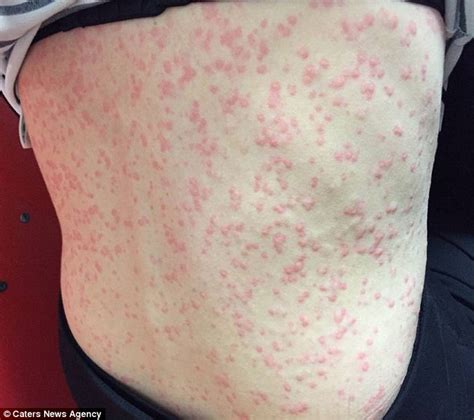 The mother who could be KILLED by cold weather: Allergic reaction means 37-year -old erupts with ...