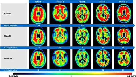 Researchers question 'misleading' surrogate evidence for FDA's Aduhelm approval