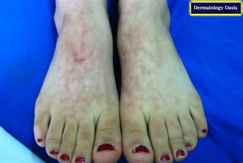 Livedo Reticularis Symptoms