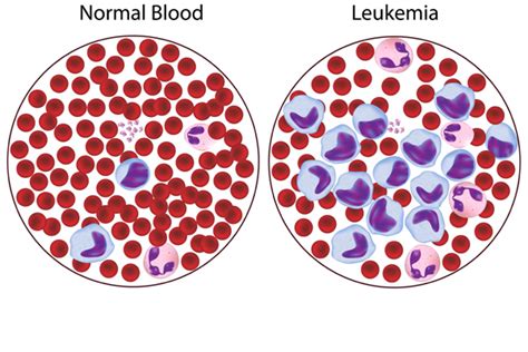 Leukemia