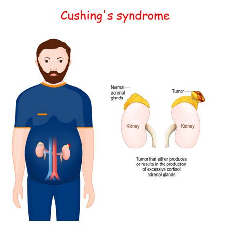 Cushing Syndrome: Everything You Need to Know - REPC