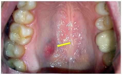 Hard Painless Lump Floor Of Mouth | Review Home Co