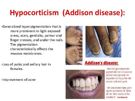 Cutaneous Manifestation of Systemic disease By Dr Eman