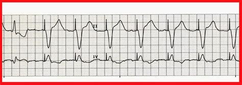 Float Nurse: Practice Rhythm Strips 302