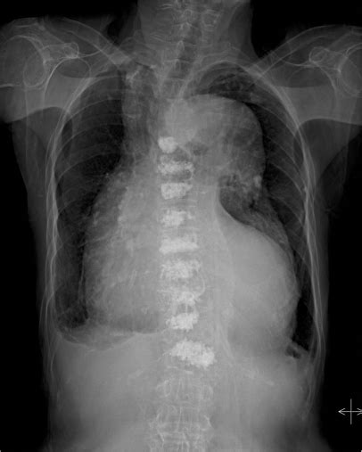 The posteroanterior chest radiograph showed an enlarged | Open-i